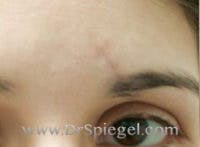Scar Revision Before & After Gallery - Patient 141931 - Image 1