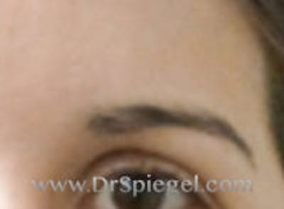 Scar Revision Before & After Gallery - Patient 141931 - Image 2