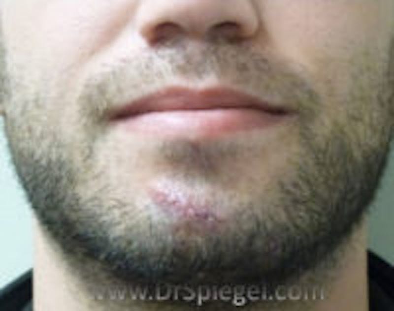Scar Revision Before & After Gallery - Patient 424753 - Image 1