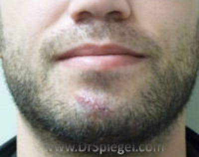 Scar Revision Before & After Gallery - Patient 424753 - Image 1
