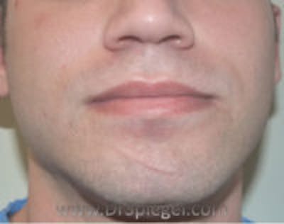 Scar Revision Before & After Gallery - Patient 424753 - Image 2