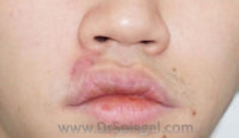 Scar Revision Before & After Gallery - Patient 265570 - Image 1