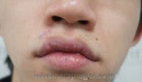 Scar Revision Before & After Gallery - Patient 265570 - Image 2