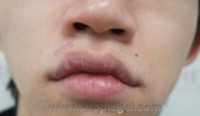 Scar Revision Before & After Gallery - Patient 265570 - Image 2