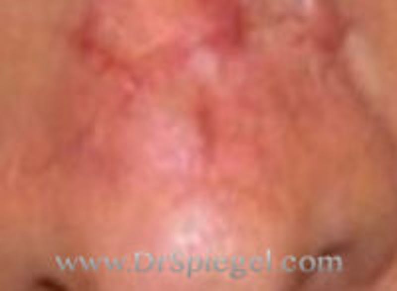 Scar Revision Before & After Gallery - Patient 260799 - Image 1