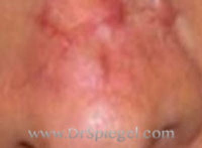 Scar Revision Before & After Gallery - Patient 260799 - Image 1