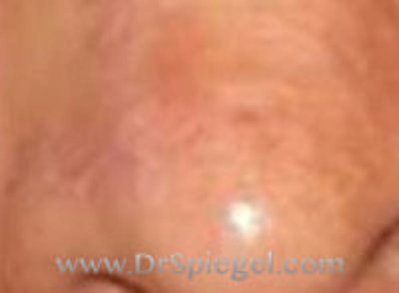 Scar Revision Before & After Gallery - Patient 260799 - Image 2