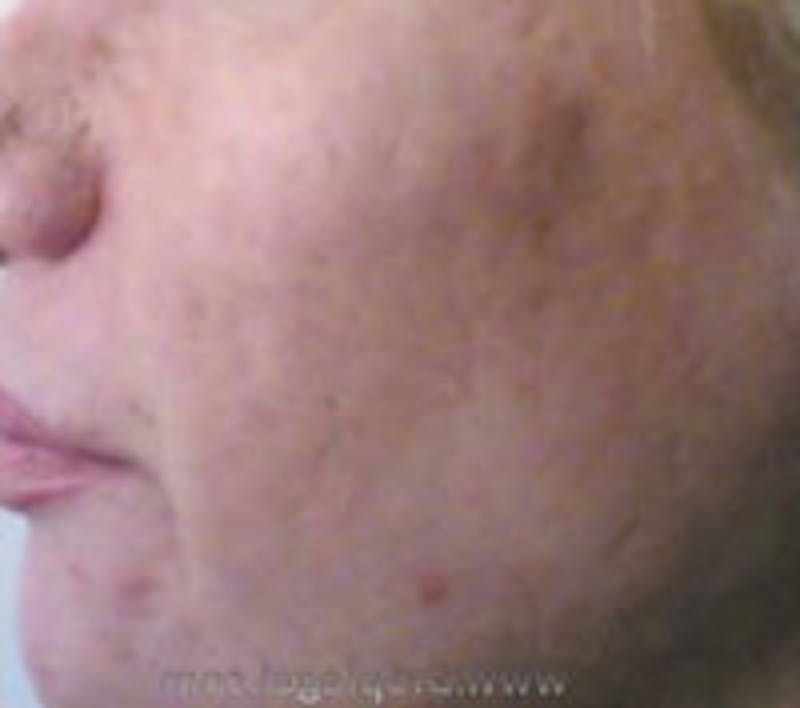 Scar Revision Before & After Gallery - Patient 392588 - Image 1