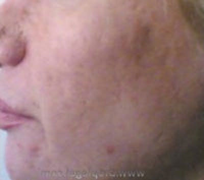 Scar Revision Before & After Gallery - Patient 392588 - Image 1