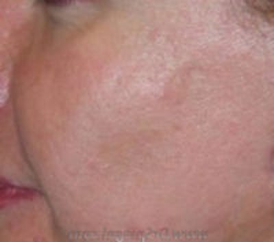 Scar Revision Before & After Gallery - Patient 392588 - Image 2