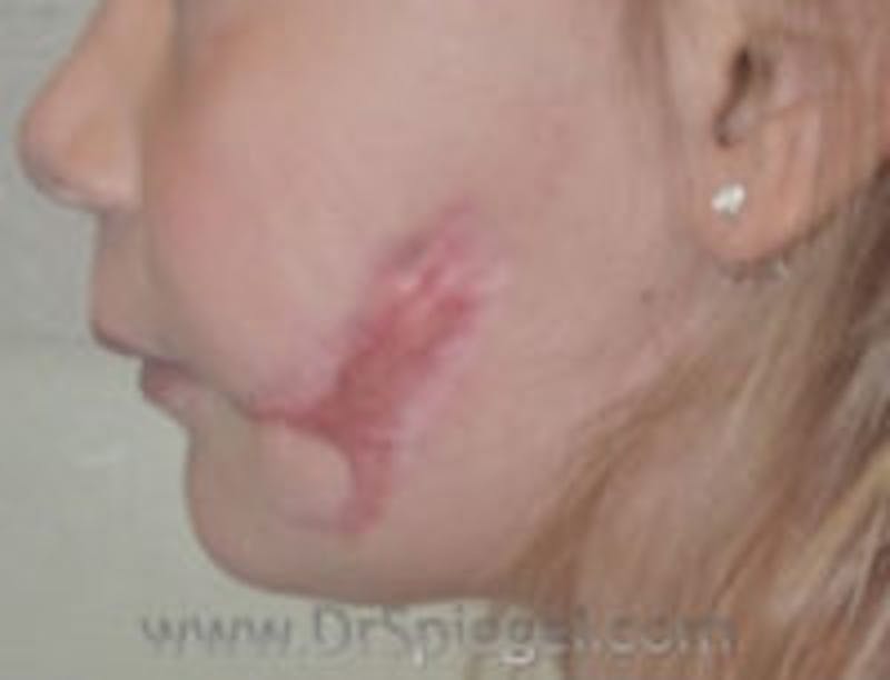 Scar Revision Before & After Gallery - Patient 402979 - Image 1
