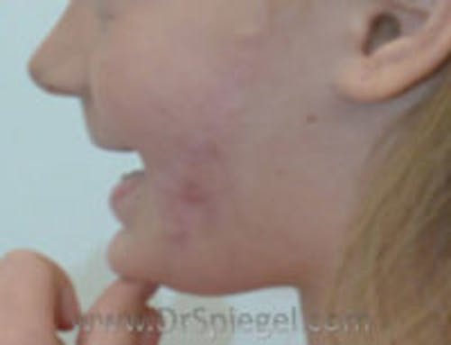 Scar Revision Before & After Gallery - Patient 402979 - Image 2