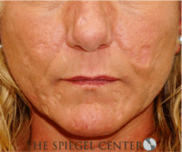 Scar Revision Before & After Gallery - Patient 328351 - Image 1