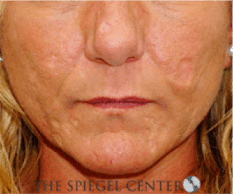 Scar Revision Before & After Gallery - Patient 328351 - Image 1