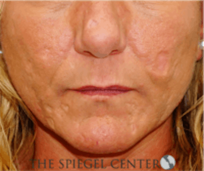 Scar Revision Before & After Gallery - Patient 328351 - Image 1