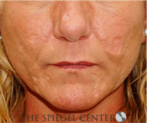 Scar Revision Before & After Gallery - Patient 328351 - Image 1