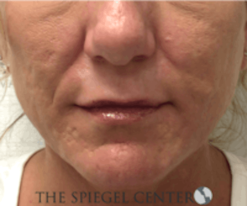 Scar Revision Before & After Gallery - Patient 328351 - Image 2