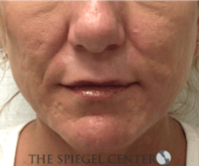Scar Revision Before & After Gallery - Patient 328351 - Image 2