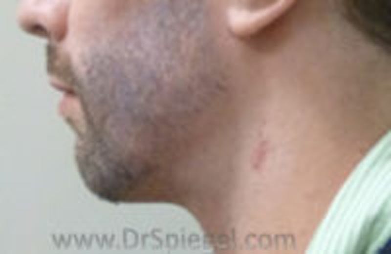 Scar Revision Before & After Gallery - Patient 423467 - Image 1
