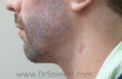 Scar Revision Before & After Gallery - Patient 423467 - Image 1