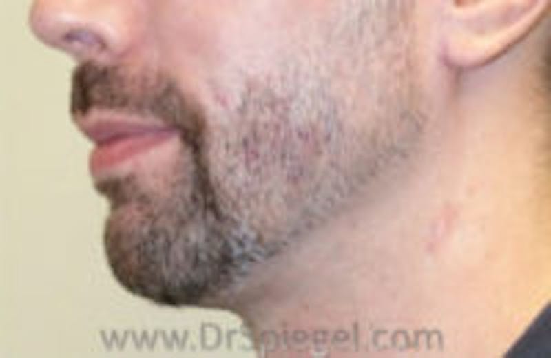 Scar Revision Before & After Gallery - Patient 423467 - Image 2