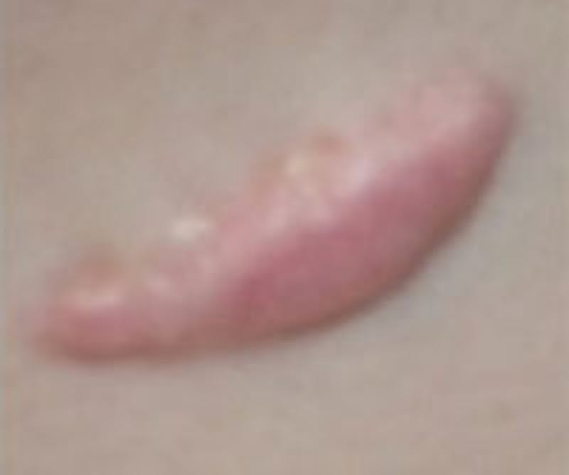 Scar Revision Before & After Gallery - Patient 271352 - Image 1