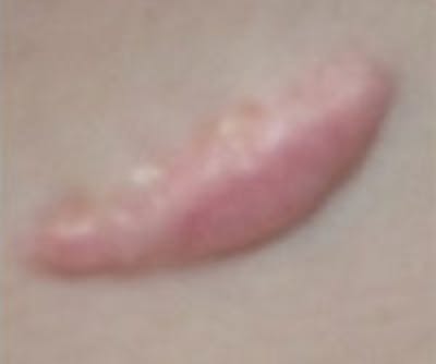 Scar Revision Before & After Gallery - Patient 271352 - Image 1