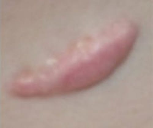 Scar Revision Before & After Gallery - Patient 271352 - Image 1