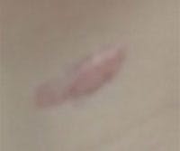 Scar Revision Before & After Gallery - Patient 271352 - Image 2