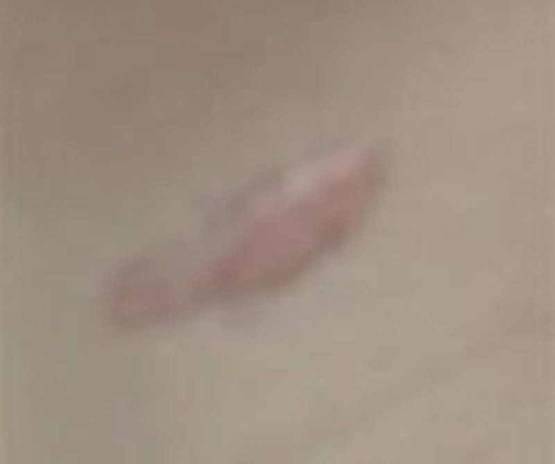 Scar Revision Before & After Gallery - Patient 271352 - Image 2