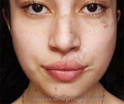 Scar Revision Before & After Gallery - Patient 322536 - Image 1