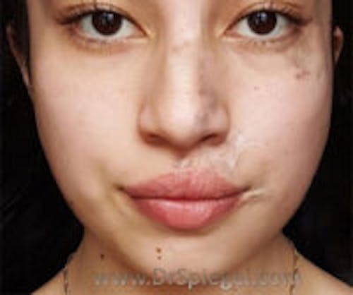 Scar Revision Before & After Gallery - Patient 322536 - Image 1