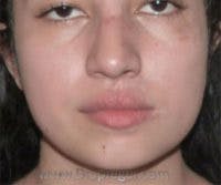 Scar Revision Before & After Gallery - Patient 322536 - Image 2
