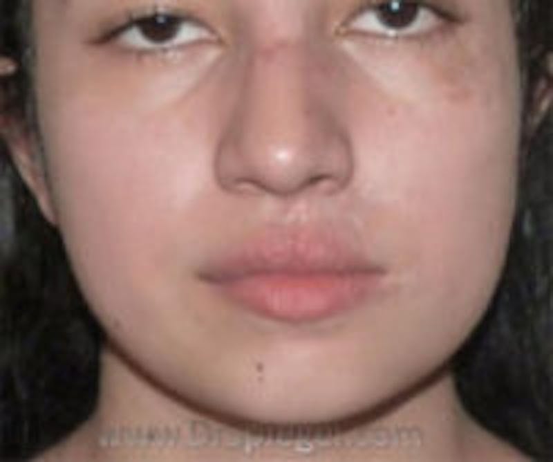 Scar Revision Before & After Gallery - Patient 322536 - Image 2