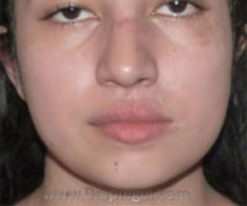 Scar Revision Before & After Gallery - Patient 322536 - Image 2