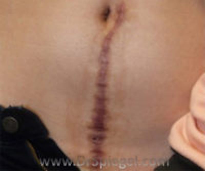 Scar Revision Before & After Gallery - Patient 186411 - Image 1