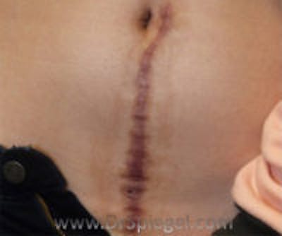 Scar Revision Before & After Gallery - Patient 186411 - Image 1