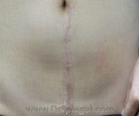 Scar Revision Before & After Gallery - Patient 186411 - Image 2