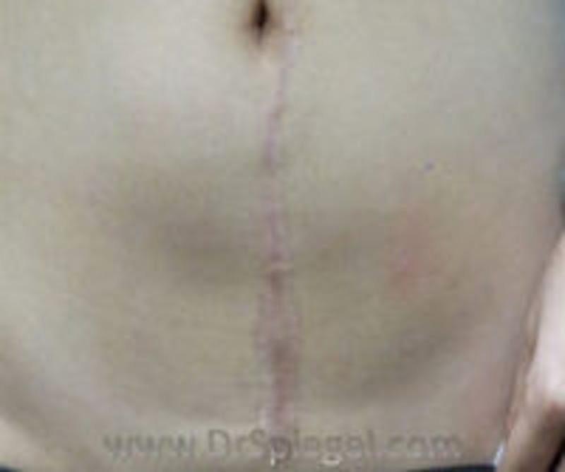 Scar Revision Before & After Gallery - Patient 186411 - Image 2