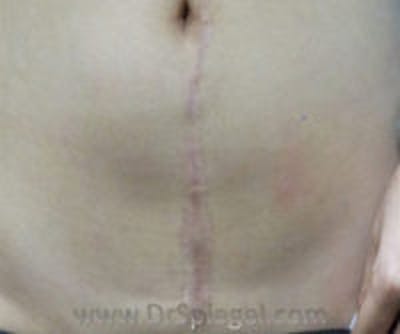 Scar Revision Before & After Gallery - Patient 186411 - Image 2