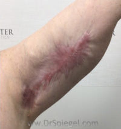 Scar Revision Before & After Gallery - Patient 590039 - Image 1