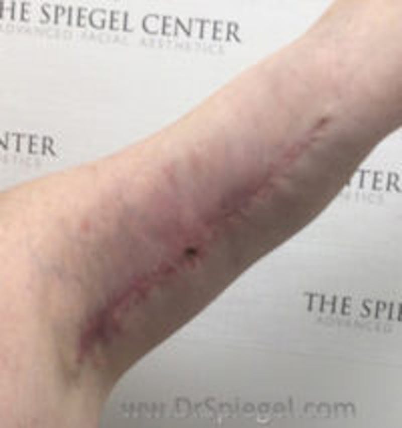Scar Revision Before & After Gallery - Patient 590039 - Image 2