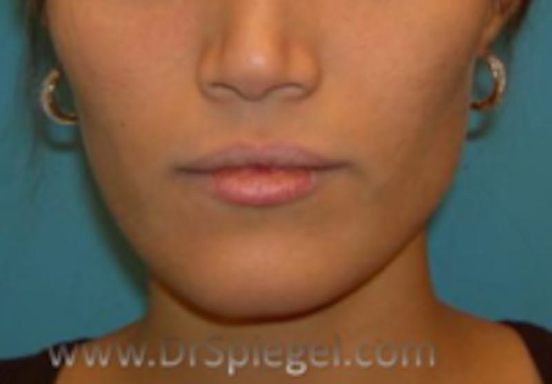 Asian Mandible Contouring Before & After Gallery - Patient 200591 - Image 1