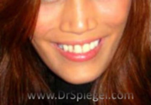 Asian Mandible Contouring Before & After Gallery - Patient 200591 - Image 2
