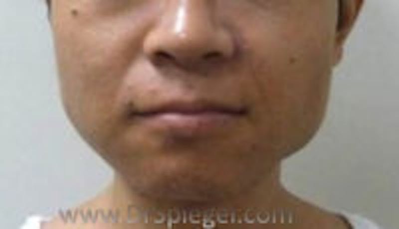 Asian Mandible Contouring Before & After Gallery - Patient 273903 - Image 1