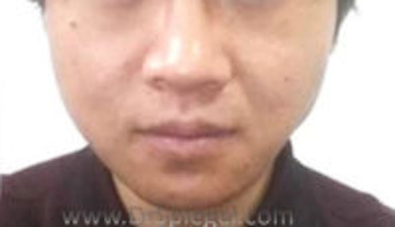 Asian Mandible Contouring Before & After Gallery - Patient 273903 - Image 2