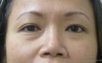 Monolid/Double Eyelid Surgery Before & After Gallery - Patient 768714 - Image 1