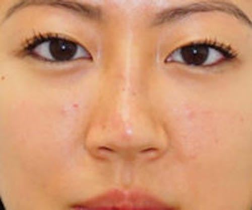 Non-Surgical Rhinoplasty Before & After Gallery - Patient 161206 - Image 1