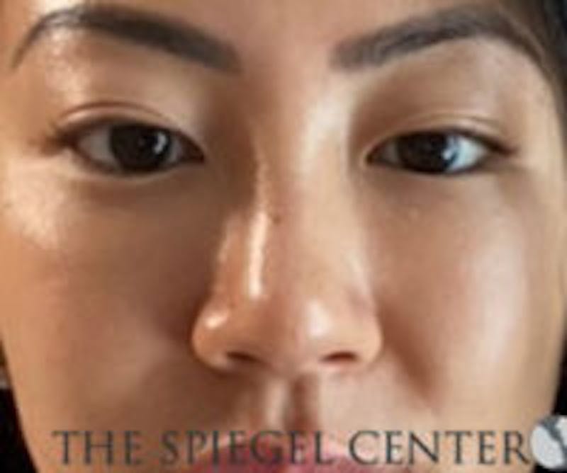 Non-Surgical Rhinoplasty Before & After Gallery - Patient 161206 - Image 2