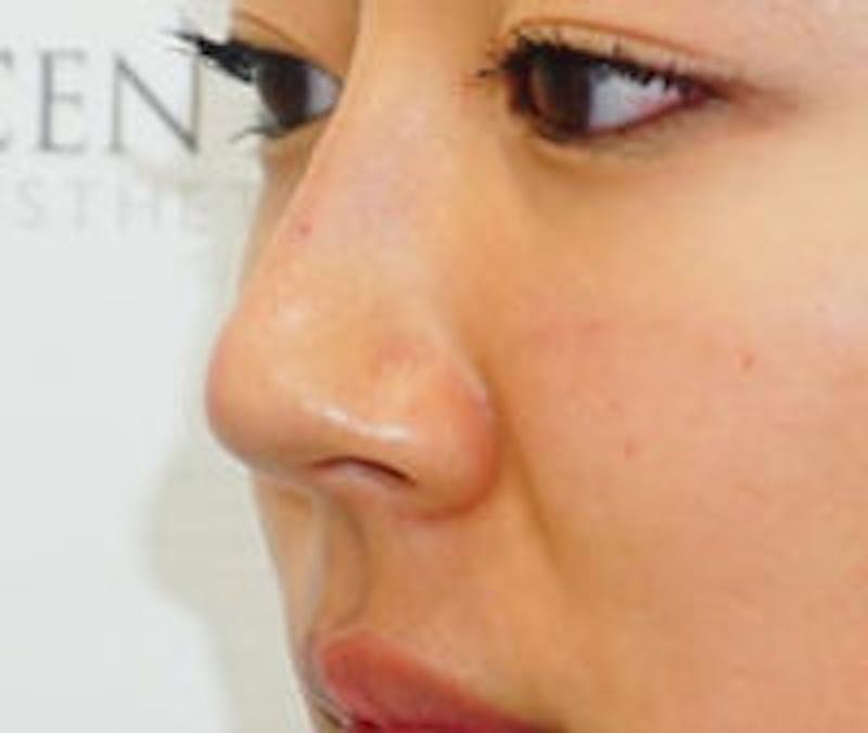 Non-Surgical Rhinoplasty Before & After Gallery - Patient 161206 - Image 3